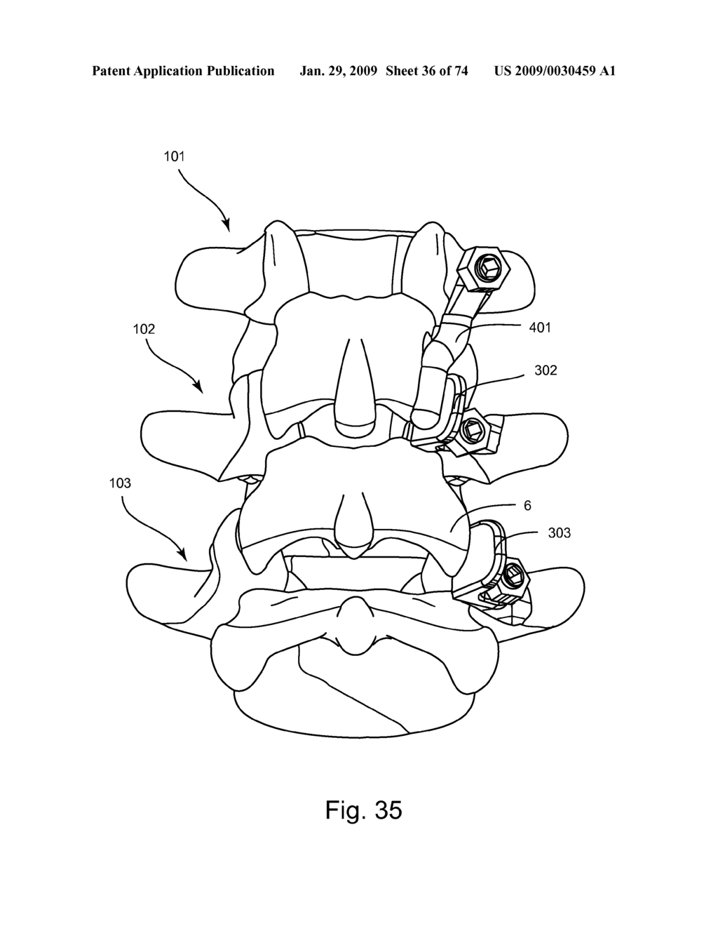 SPINAL FACET IMPLANT WITH SPHERICAL IMPLANT APPOSITION SURFACE AND BONE BED AND METHODS OF USE - diagram, schematic, and image 37