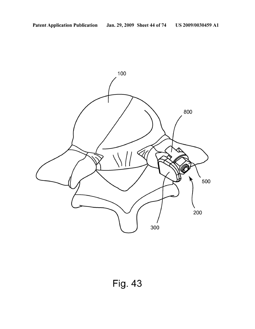 SPINAL FACET IMPLANT WITH SPHERICAL IMPLANT APPOSITION SURFACE AND BONE BED AND METHODS OF USE - diagram, schematic, and image 45