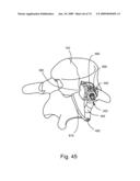 SPINAL FACET IMPLANT WITH SPHERICAL IMPLANT APPOSITION SURFACE AND BONE BED AND METHODS OF USE diagram and image