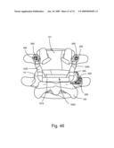 SPINAL FACET IMPLANT WITH SPHERICAL IMPLANT APPOSITION SURFACE AND BONE BED AND METHODS OF USE diagram and image