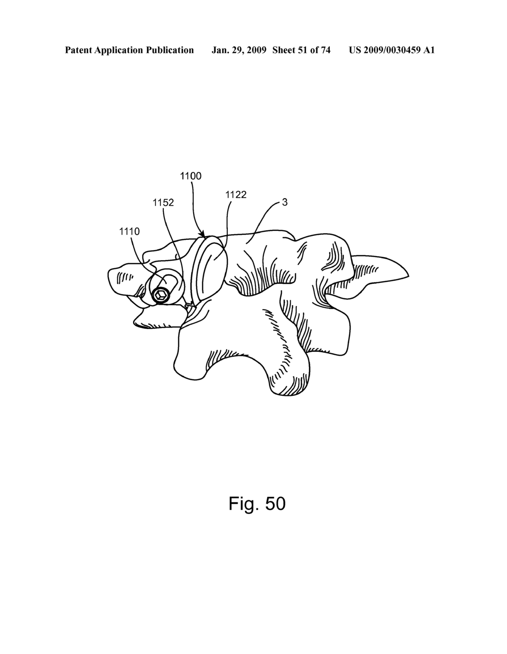 SPINAL FACET IMPLANT WITH SPHERICAL IMPLANT APPOSITION SURFACE AND BONE BED AND METHODS OF USE - diagram, schematic, and image 52