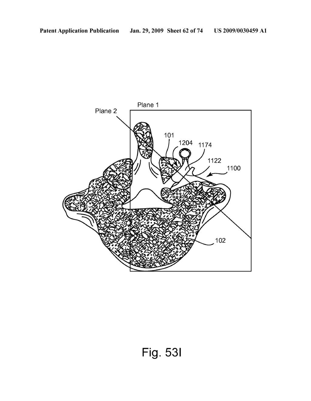 SPINAL FACET IMPLANT WITH SPHERICAL IMPLANT APPOSITION SURFACE AND BONE BED AND METHODS OF USE - diagram, schematic, and image 63