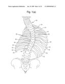 Segmental Orthopaedic device for spinal elongation and for treatment of Scoliosis diagram and image