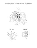 Segmental Orthopaedic device for spinal elongation and for treatment of Scoliosis diagram and image