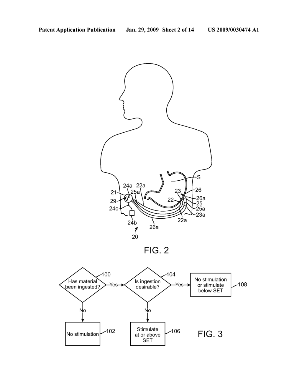 Sensor Driven Gastric Stimulation for Patient Management - diagram, schematic, and image 03