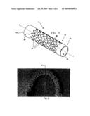 FLEXIBLE STRETCH STENT-GRAFT diagram and image