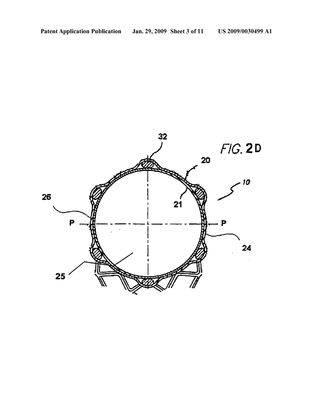 FLEXIBLE STRETCH STENT-GRAFT - diagram, schematic, and image 04