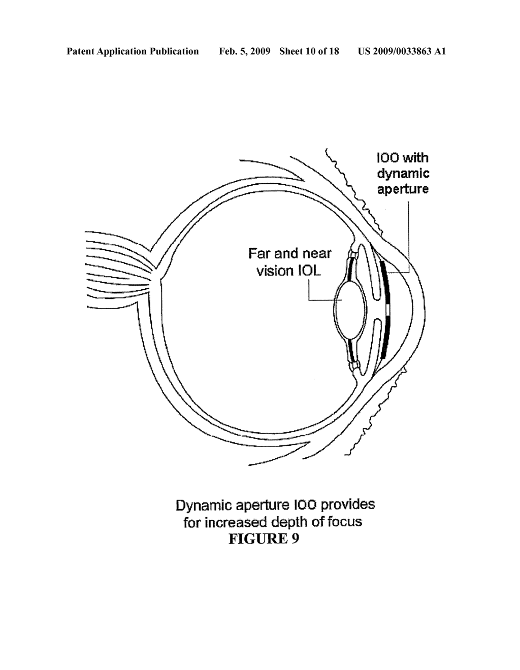 OPHTHALMIC DYNAMIC APERTURE - diagram, schematic, and image 11