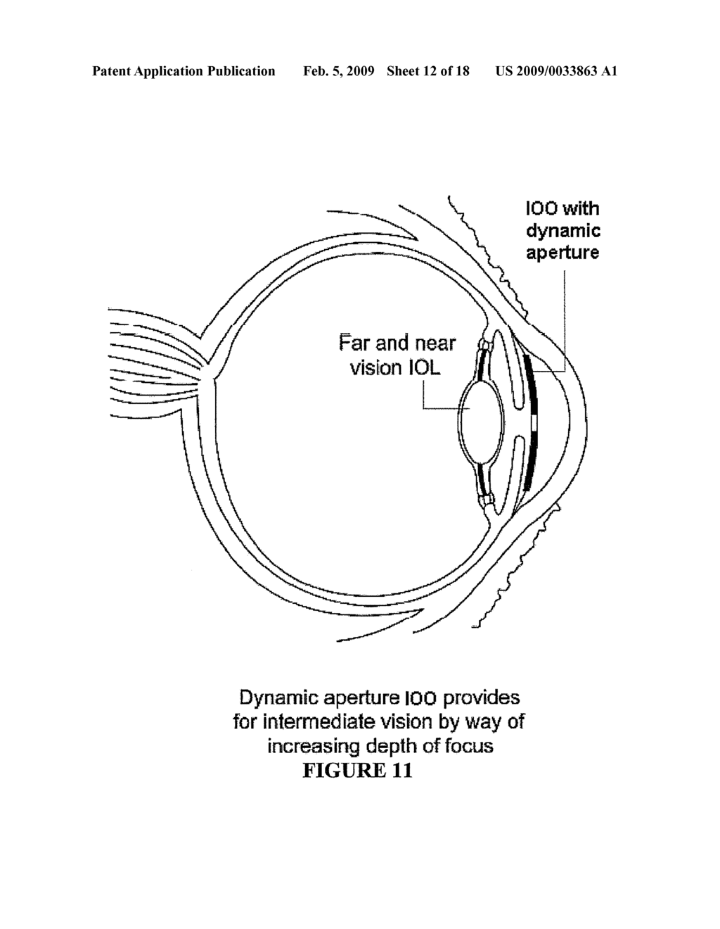 OPHTHALMIC DYNAMIC APERTURE - diagram, schematic, and image 13