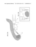 TREATMENT ENDOSCOPE diagram and image