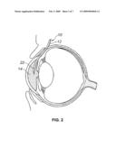 Shunt and Method Treatment of Glaucoma diagram and image