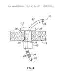 Shunt and Method Treatment of Glaucoma diagram and image