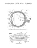 Juxtascleral Drug Delivery and Ocular Implant System diagram and image