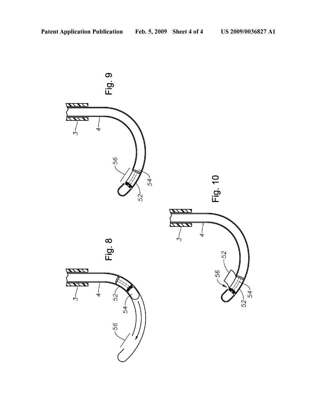 Juxtascleral Drug Delivery and Ocular Implant System - diagram, schematic, and image 05