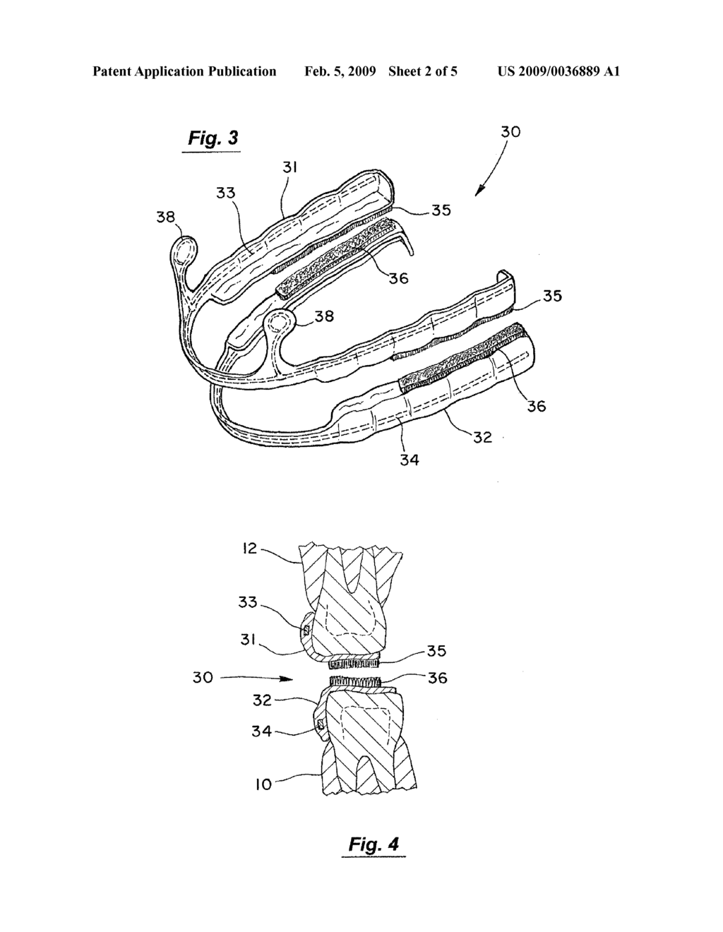 METHOD AND APPARATUS FOR TREATMENT OF SLEEP APNEA - diagram, schematic, and image 03