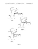 FIXATION AND ALIGNMENT DEVICE AND METHOD USED IN ORTHOPAEDIC SURGERY diagram and image