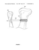 FIXATION AND ALIGNMENT DEVICE AND METHOD USED IN ORTHOPAEDIC SURGERY diagram and image