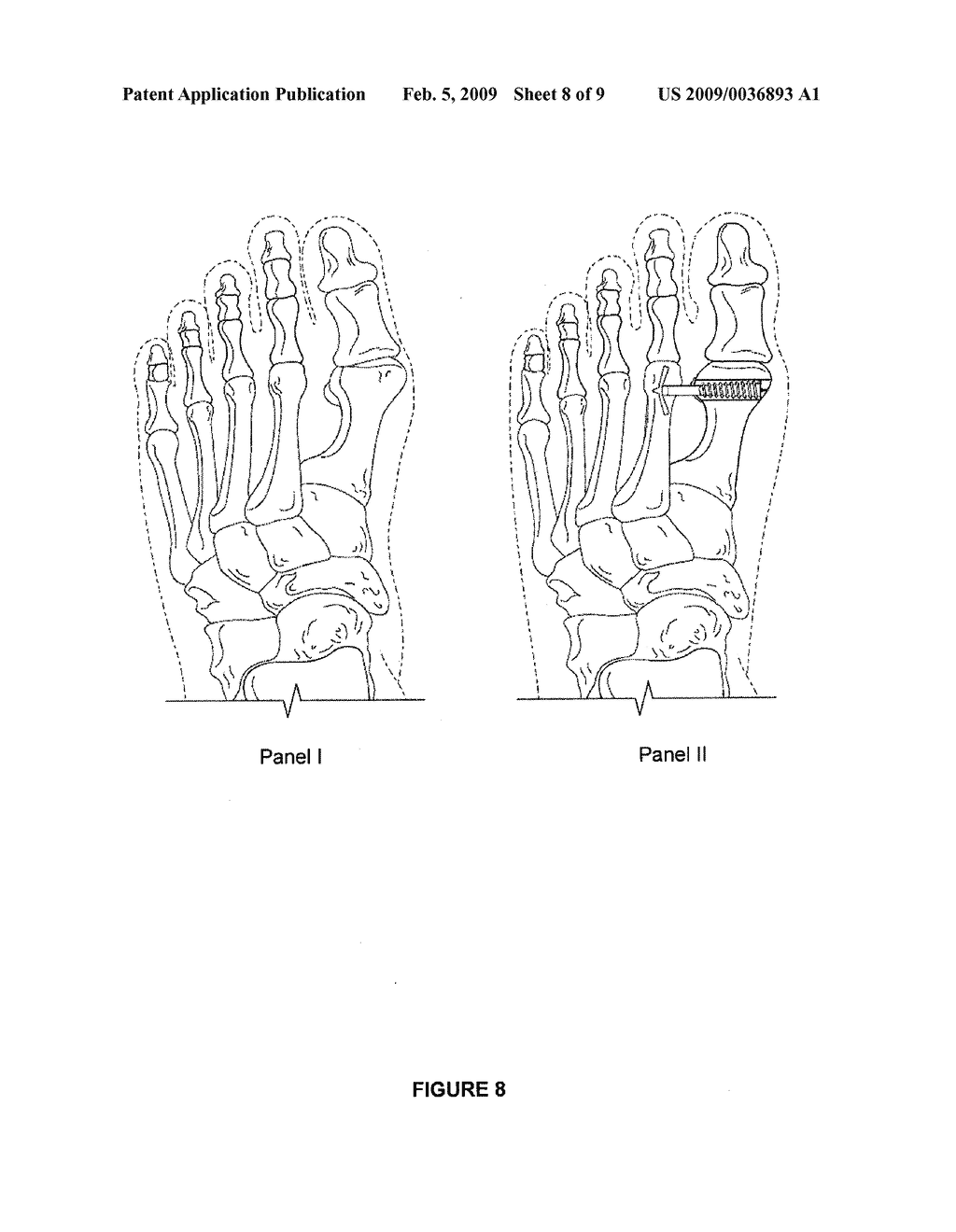 FIXATION AND ALIGNMENT DEVICE AND METHOD USED IN ORTHOPAEDIC SURGERY - diagram, schematic, and image 09