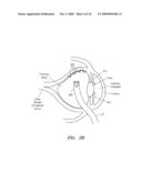 SURGERY METHODS USING A ROBOTIC INSTRUMENT SYSTEM diagram and image