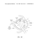 SURGERY METHODS USING A ROBOTIC INSTRUMENT SYSTEM diagram and image