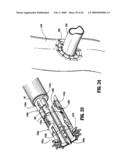 Anastomosis Instrument and Method for Performing Same diagram and image