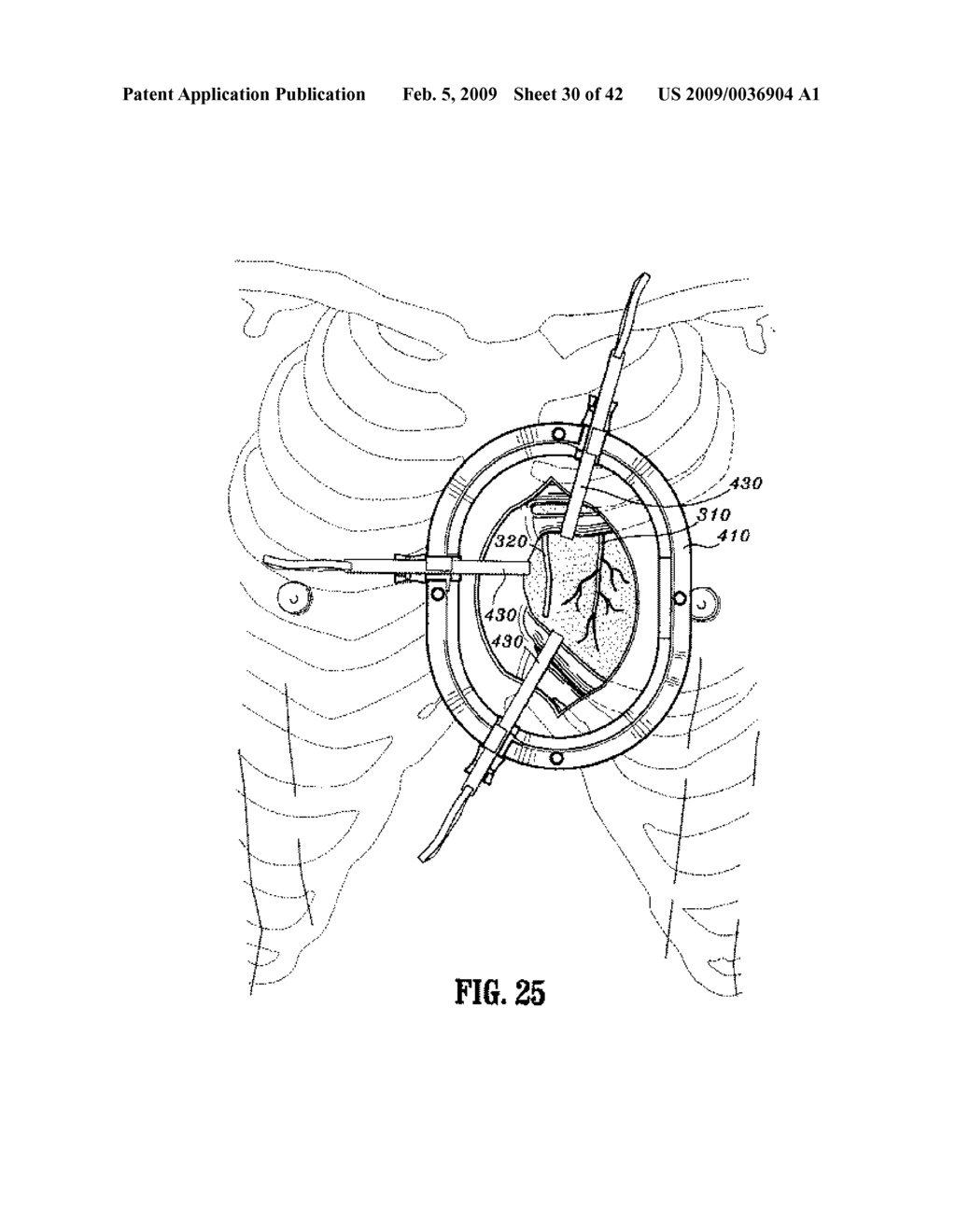 Anastomosis Instrument and Method for Performing Same - diagram, schematic, and image 31