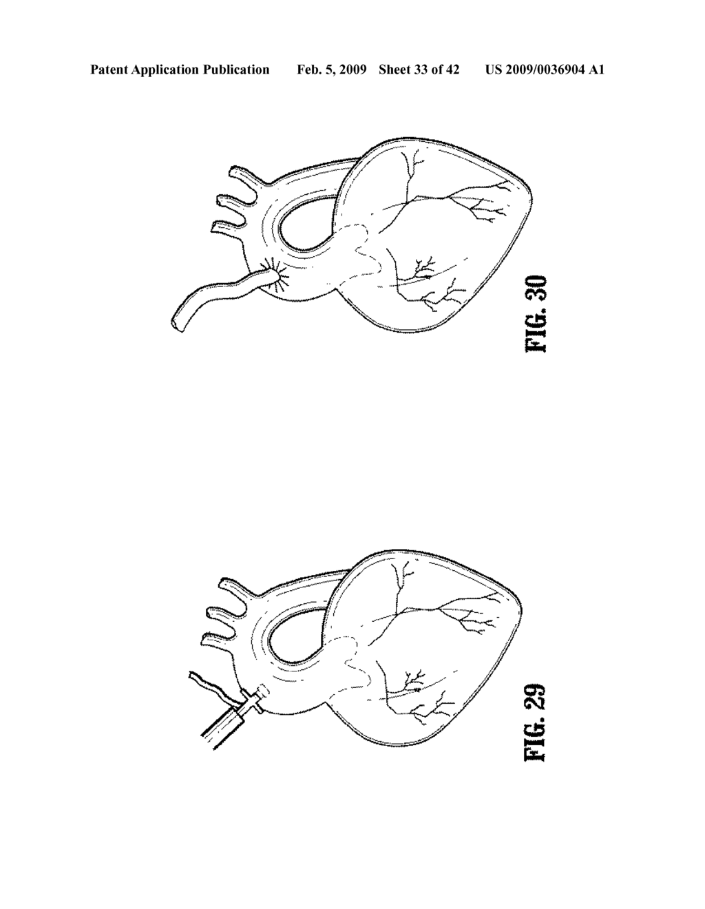 Anastomosis Instrument and Method for Performing Same - diagram, schematic, and image 34