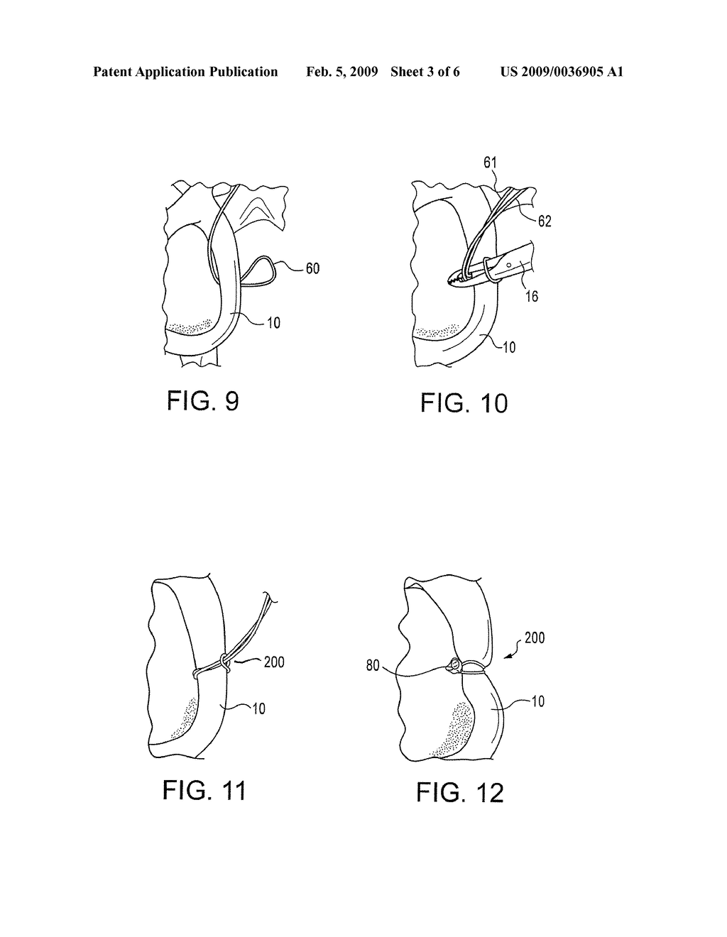 METHOD OF TISSUE FIXATION USING CINCH STITCHING - diagram, schematic, and image 04