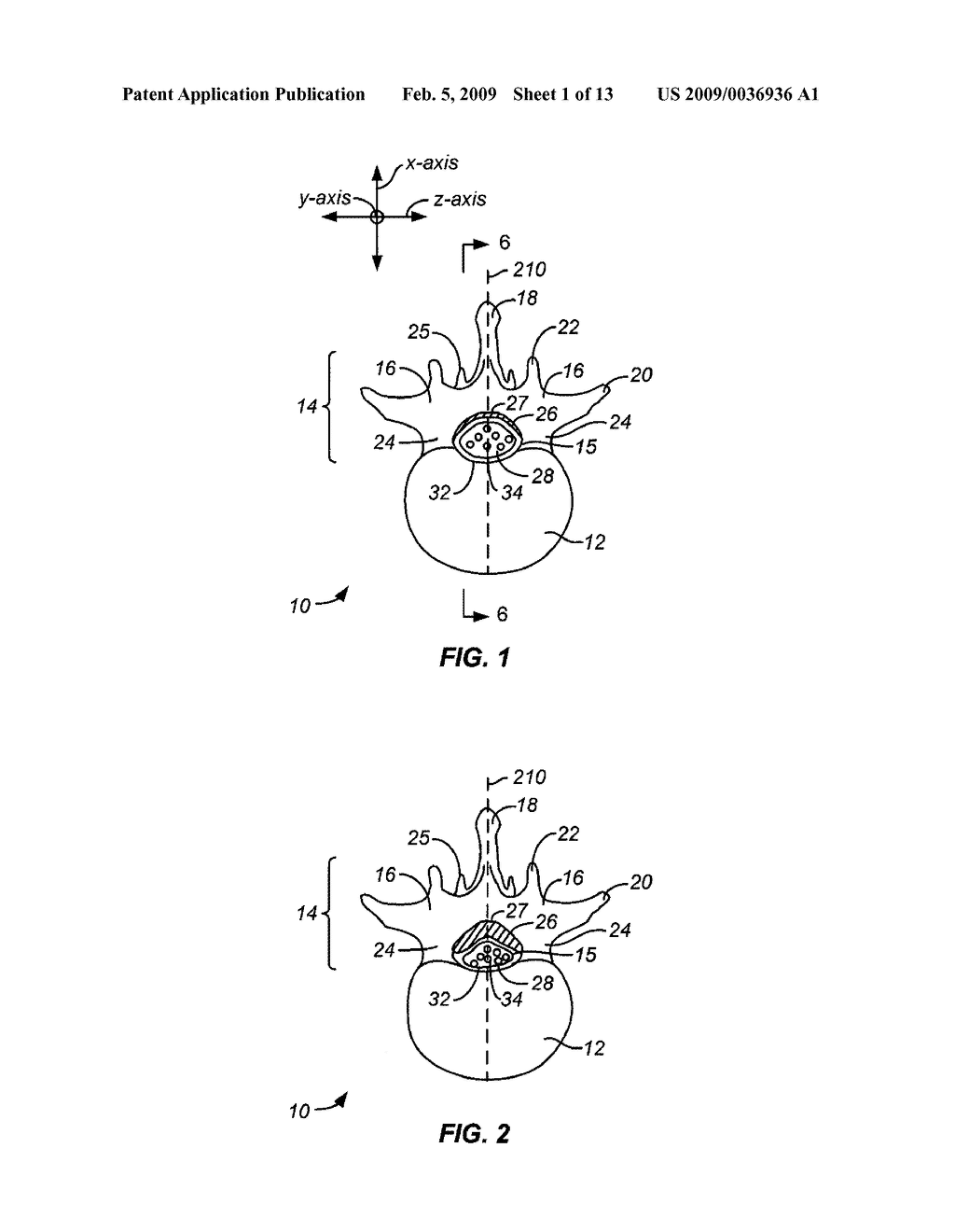 TRANSLAMINAR APPROACH TO MINIMALLY INVASIVE LIGAMENT DECOMPRESSION PROCEDURE - diagram, schematic, and image 02