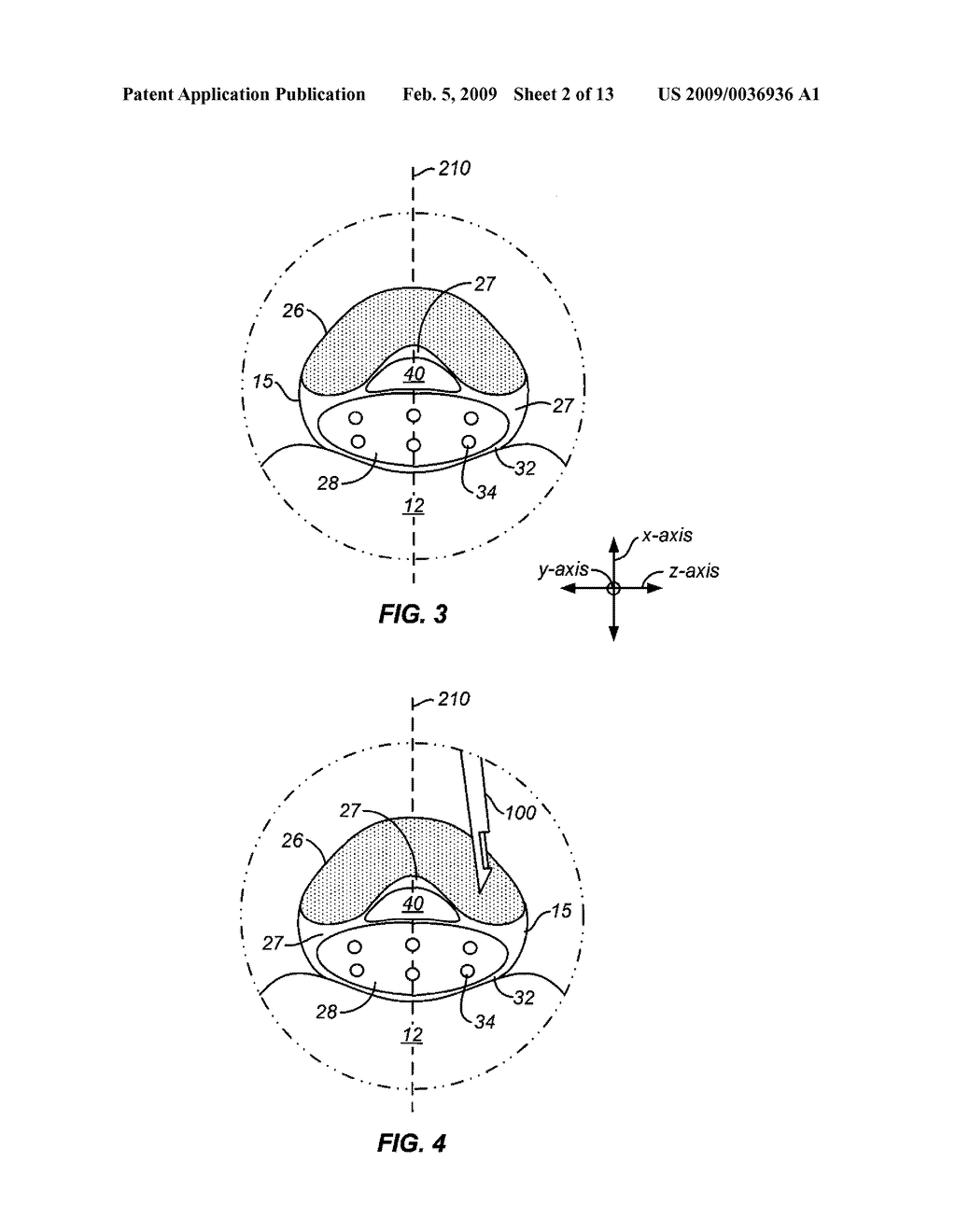 TRANSLAMINAR APPROACH TO MINIMALLY INVASIVE LIGAMENT DECOMPRESSION PROCEDURE - diagram, schematic, and image 03