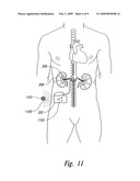 RENAL NERVE STIMULATION METHODS FOR TREATMENT OF PATIENTS diagram and image