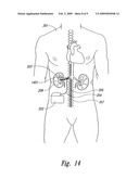 RENAL NERVE STIMULATION METHODS FOR TREATMENT OF PATIENTS diagram and image