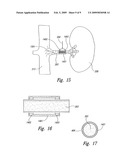 RENAL NERVE STIMULATION METHODS FOR TREATMENT OF PATIENTS diagram and image