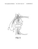 DEVICE FOR MAINTAINING PATENT PARANASAL SINUS OSTIA diagram and image