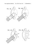 Injectable Intraocular Implants diagram and image