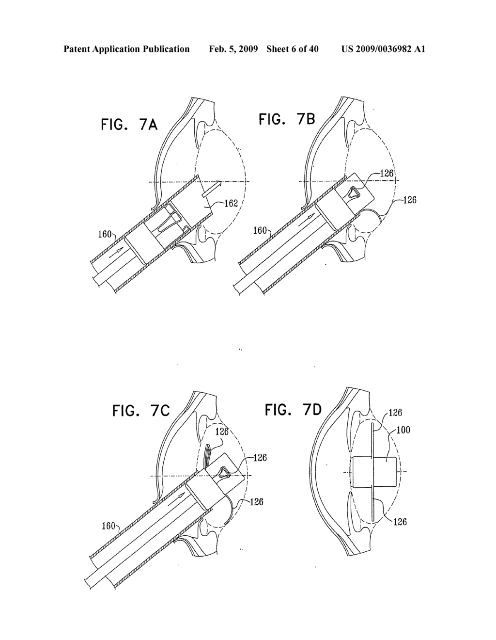 Injectable Intraocular Implants - diagram, schematic, and image 07