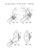 Injectable Intraocular Implants diagram and image