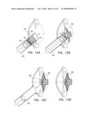 Injectable Intraocular Implants diagram and image