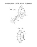 Injectable Intraocular Implants diagram and image