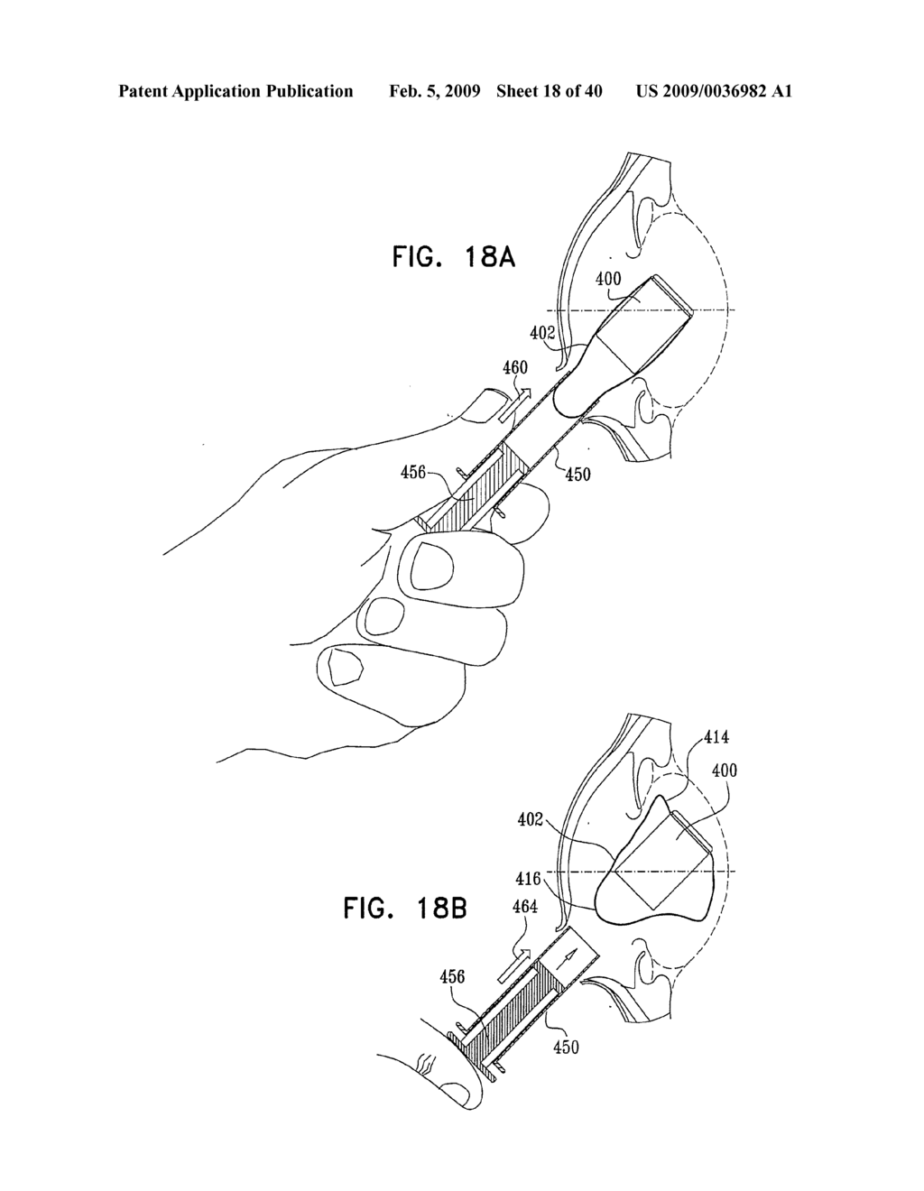 Injectable Intraocular Implants - diagram, schematic, and image 19