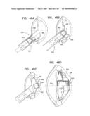 Injectable Intraocular Implants diagram and image