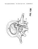 Method and Apparatus for the Treatment of the Intervertebral Disc Annulus diagram and image