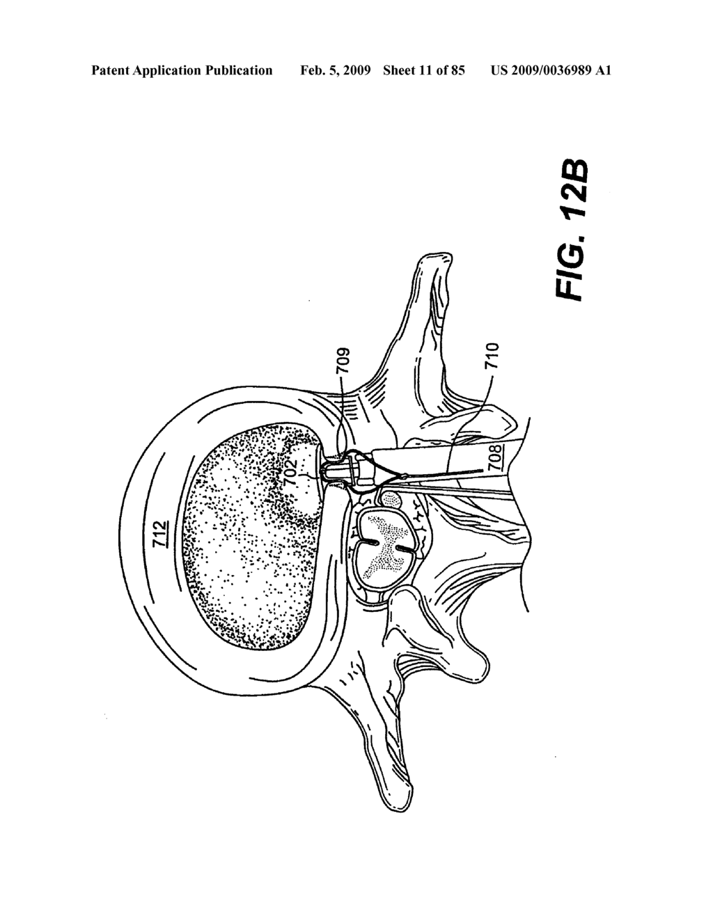 Method and Apparatus for the Treatment of the Intervertebral Disc Annulus - diagram, schematic, and image 12