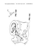 Method and Apparatus for the Treatment of the Intervertebral Disc Annulus diagram and image