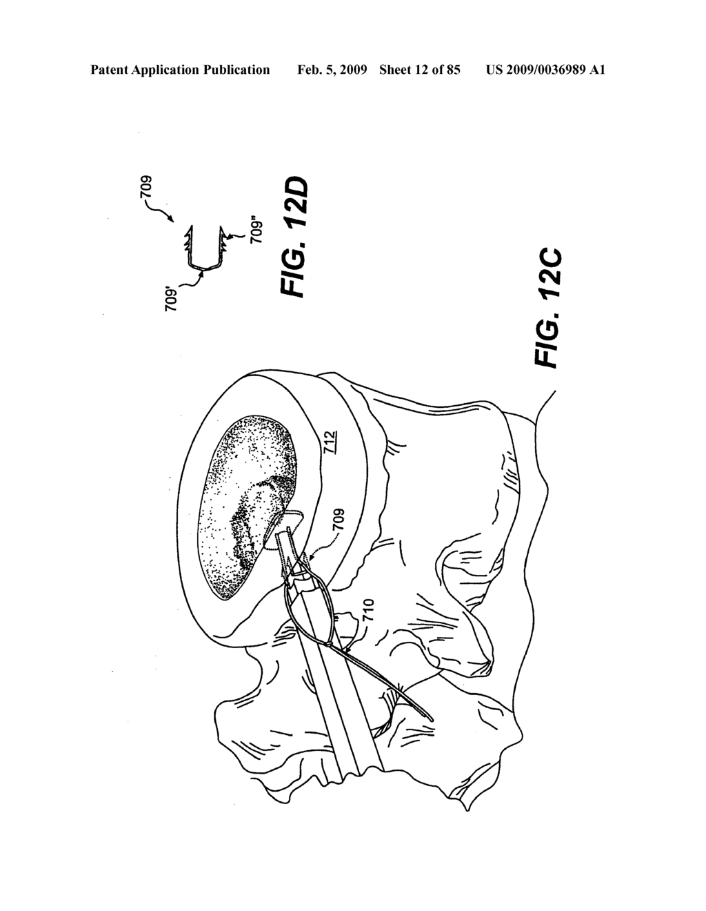 Method and Apparatus for the Treatment of the Intervertebral Disc Annulus - diagram, schematic, and image 13