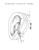 Method and Apparatus for the Treatment of the Intervertebral Disc Annulus diagram and image