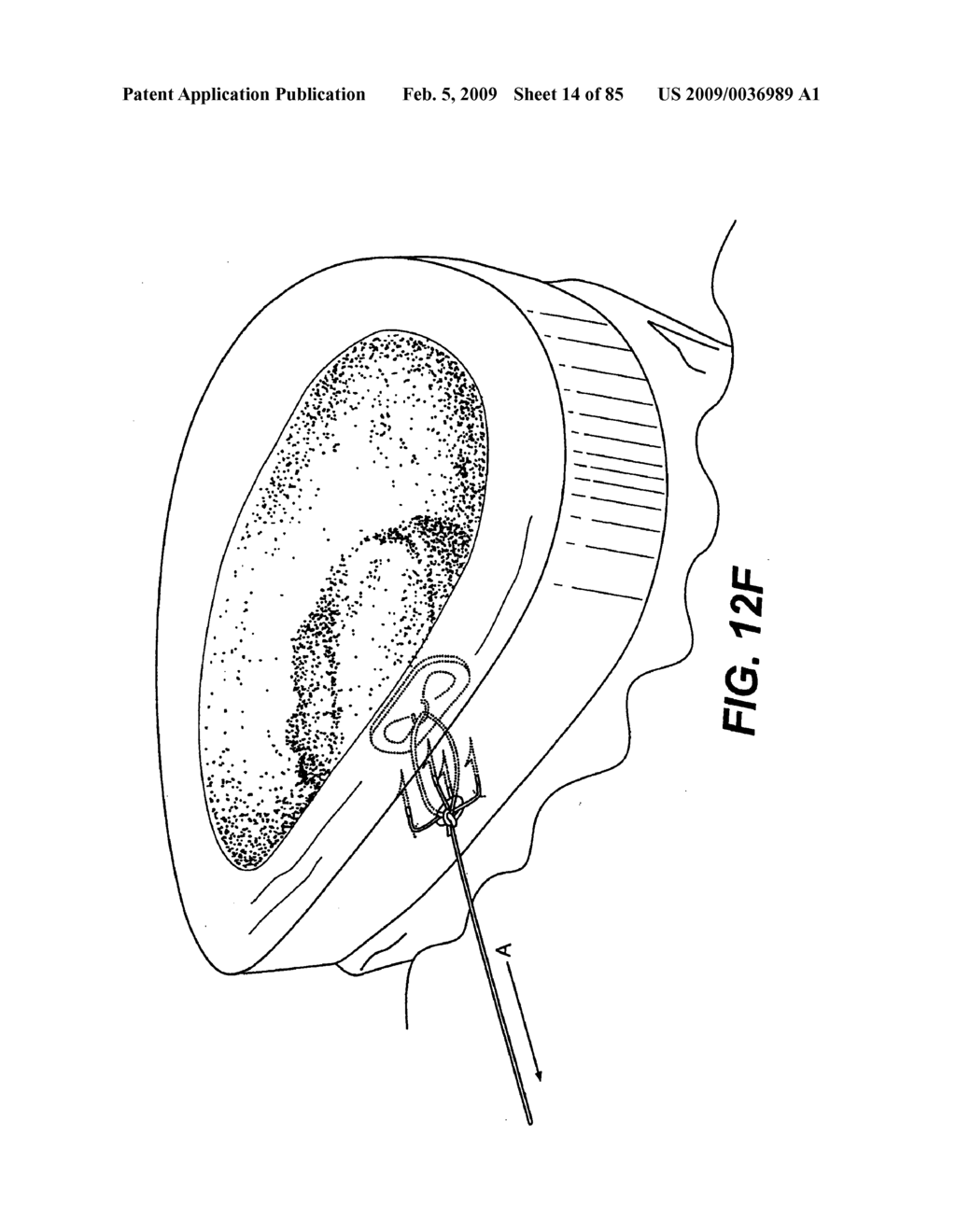 Method and Apparatus for the Treatment of the Intervertebral Disc Annulus - diagram, schematic, and image 15