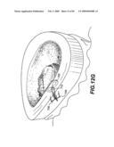 Method and Apparatus for the Treatment of the Intervertebral Disc Annulus diagram and image