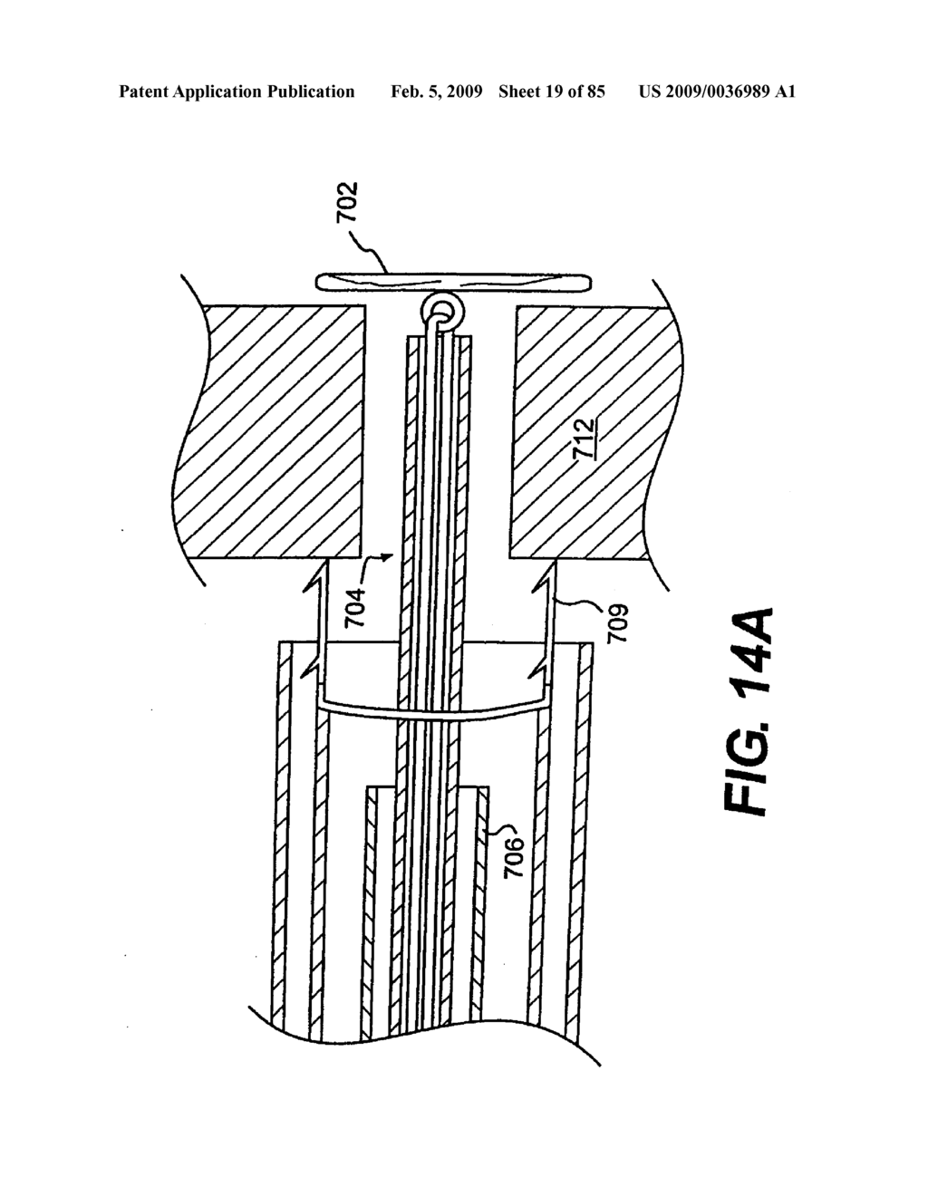 Method and Apparatus for the Treatment of the Intervertebral Disc Annulus - diagram, schematic, and image 20