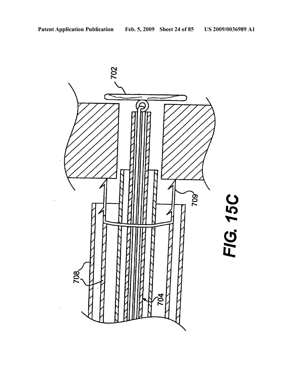 Method and Apparatus for the Treatment of the Intervertebral Disc Annulus - diagram, schematic, and image 25